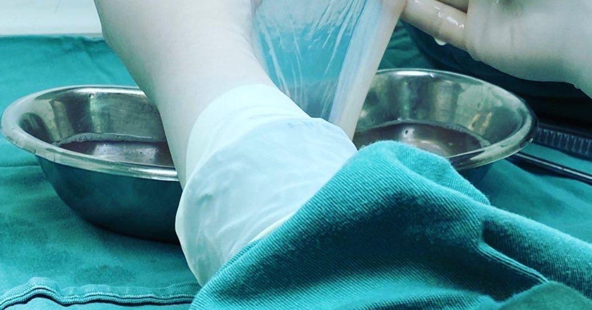 Membrana retirada no parto recebe aval para ser usada no tratamento de queimaduras no SUS