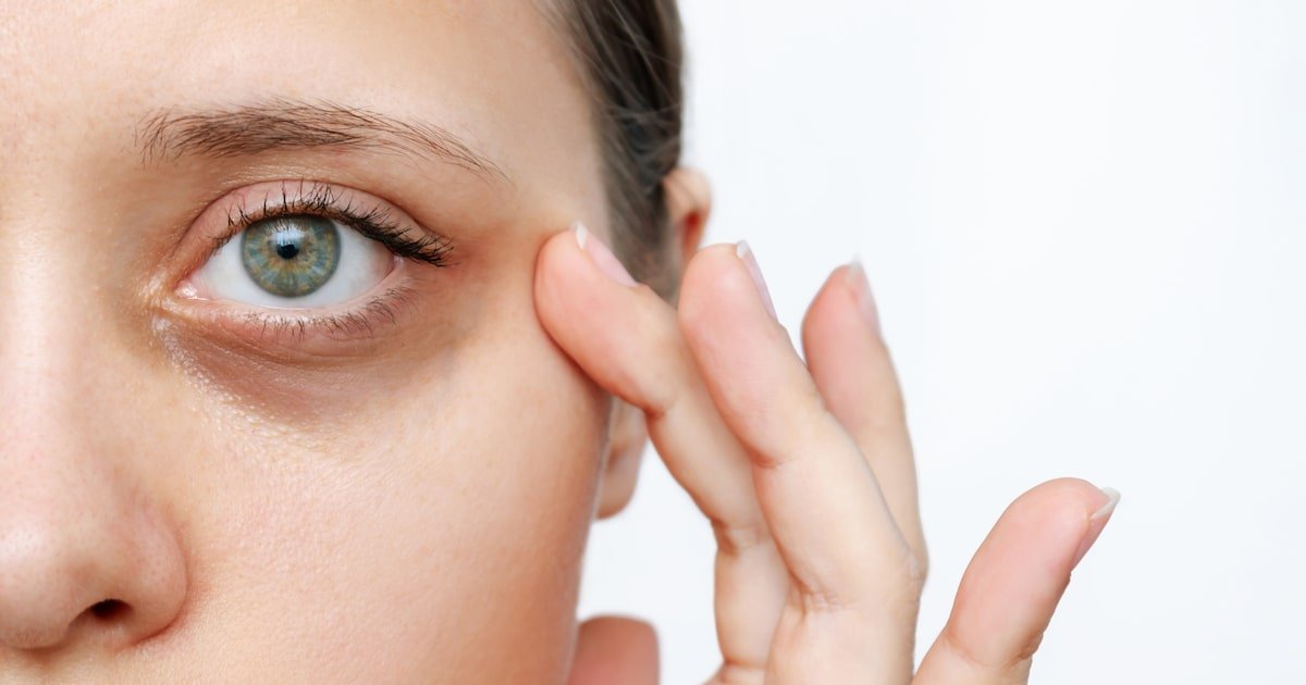 Veja dicas simples para melhorar olheiras e bolsas sob os olhos