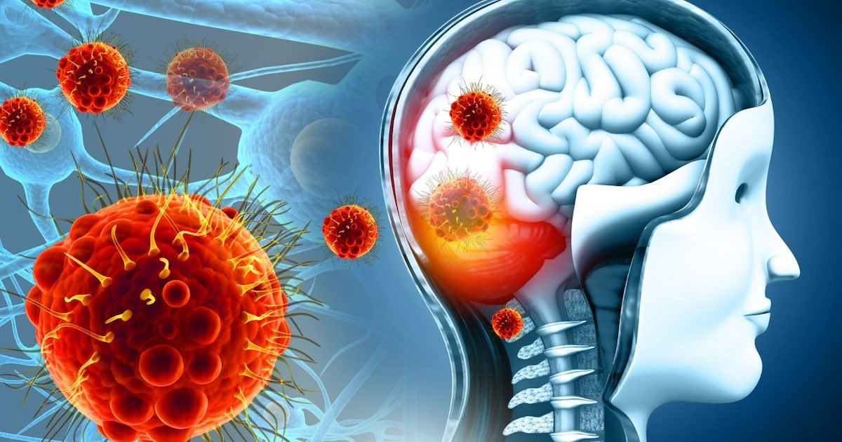 Resistência bacteriana ameaça tratamento indicado para meningite no Brasil, aponta estudo