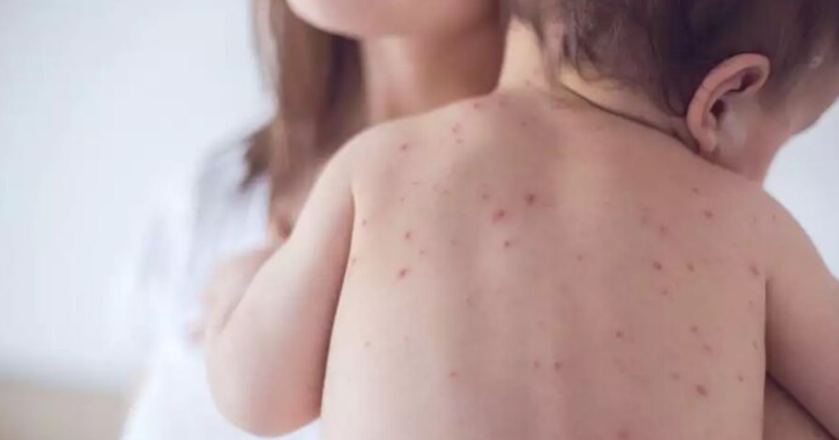 Sarampo: veja sintomas, diferenças para a catapora e se é possível se infectar mais de uma vez