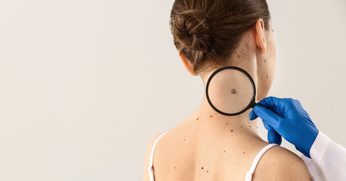 Pesquisa identifica genes que podem prever resposta de pacientes com melanoma à imunoterapia