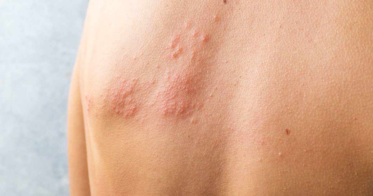 Herpes-zóster em crianças é raro, mas pode acontecer; conheça sintomas e tratamentos